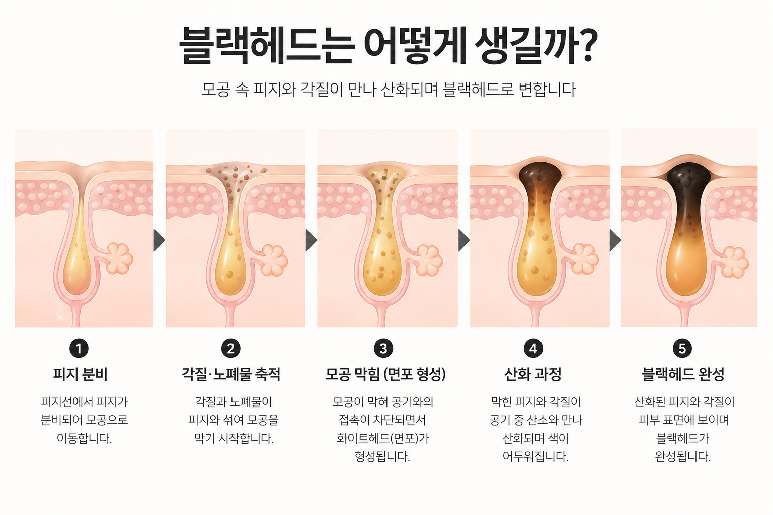 블랙헤드 발생 원인 4가지와 모공 관리 방법을 설명하는 피부 이미지