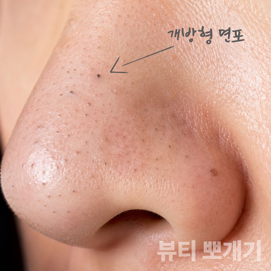 블랙헤드 확대 사진으로 확인하는 모공 속 피지와 각질 상태
