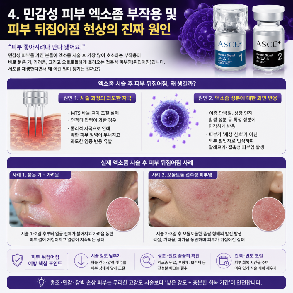 민감성 피부 엑소좀 스킨부스터 부작용 사례 인포그래픽 이미지. 엑소좀 시술 후 붉은기, 가려움, 접촉성 피부염, 오돌토돌 피부 뒤집어짐 원인과 실제 사례를 설명하며, 피부 장벽 손상과 과민 반응 메커니즘 및 예방 포인트를 정리한 의료·뷰티 콘텐츠.