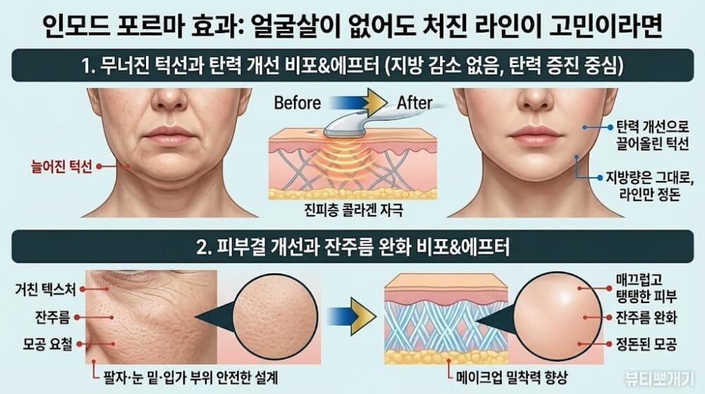얼굴살이 없는 처진 피부의 탄력 개선 및 피부결 잔주름 완화 효과를 보여주는 인모드 포르마 시술 전후 실사 비교