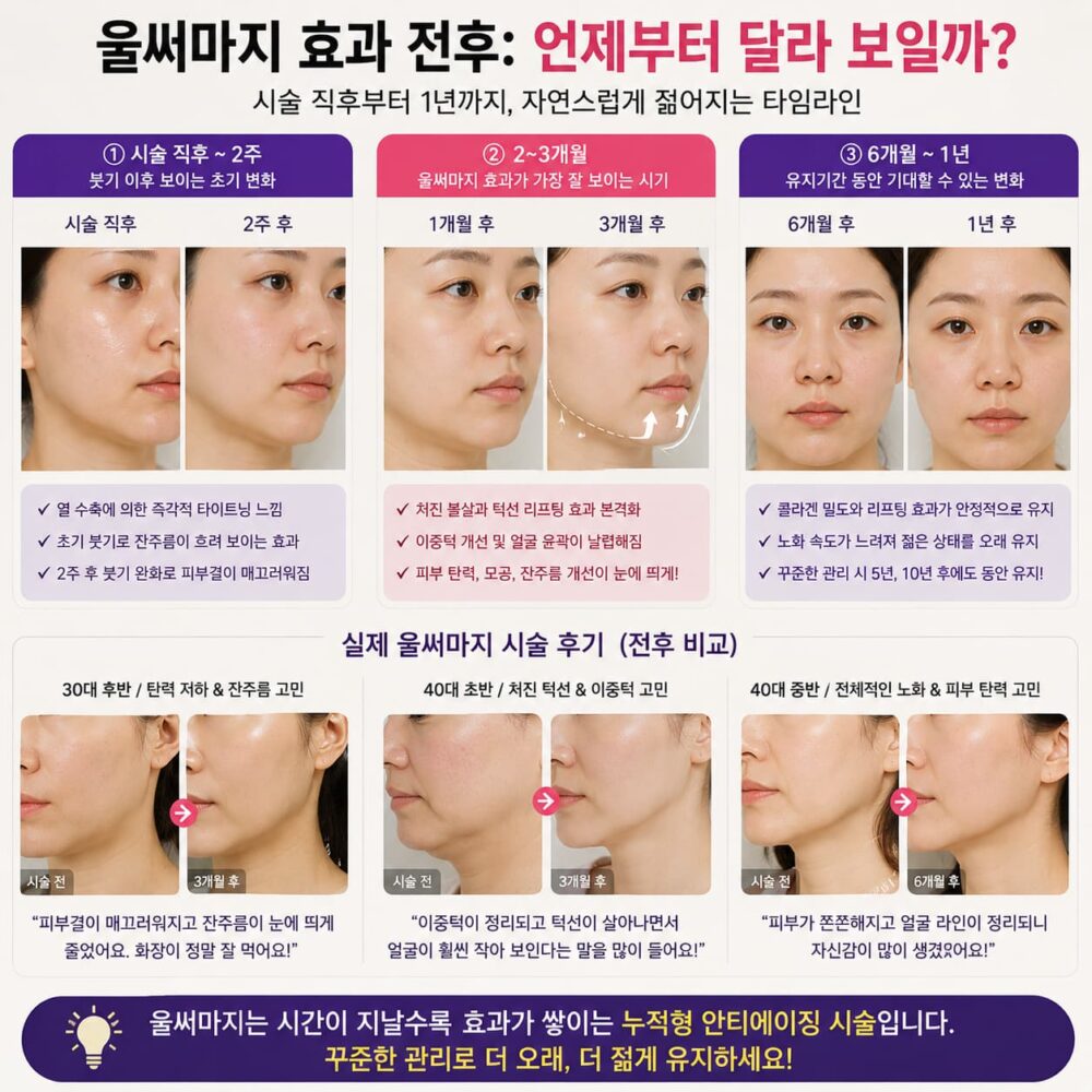 울써마지 효과 전후 변화를 시술 직후부터 1년까지 타임라인으로 보여주는 실사 비교 인포그래픽으로, 리프팅과 피부 탄력 개선 과정을 시기별 전후 사진과 함께 설명한 이미지.