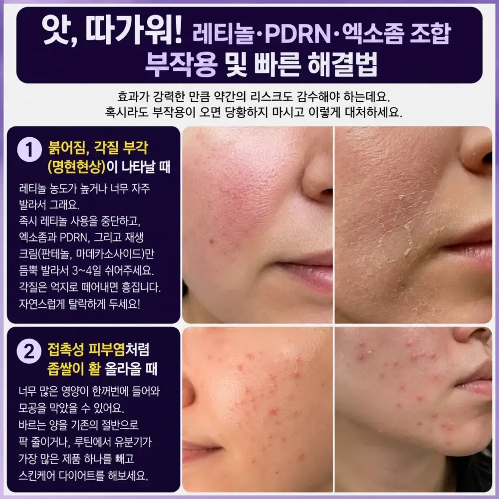 고농도 레티놀 부작용으로 인한 피부 붉어짐 및 각질 부각 현상 발생 시 엑소좀 PDRN 재생크림을 활용한 대처법
