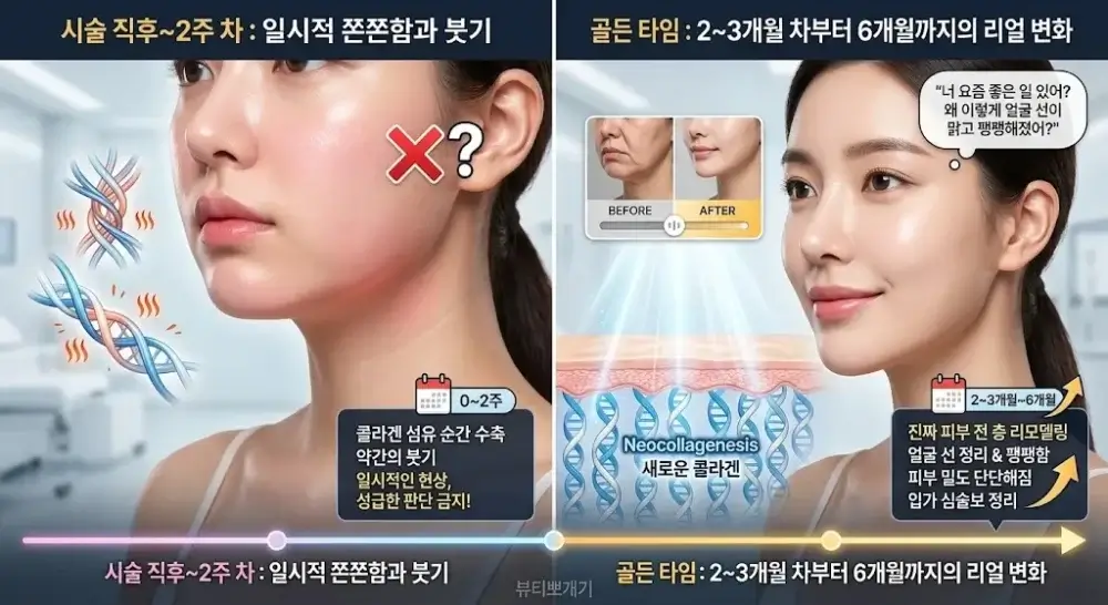 울써마지 시술 후 기간별 탄력 효과 추이 그래프 (시술 직후 일시적 콜라겐 수축 및 붓기 효과에서부터 2~3개월 차 새로운 콜라겐 생성 골든 타임까지의 가시적 변화)