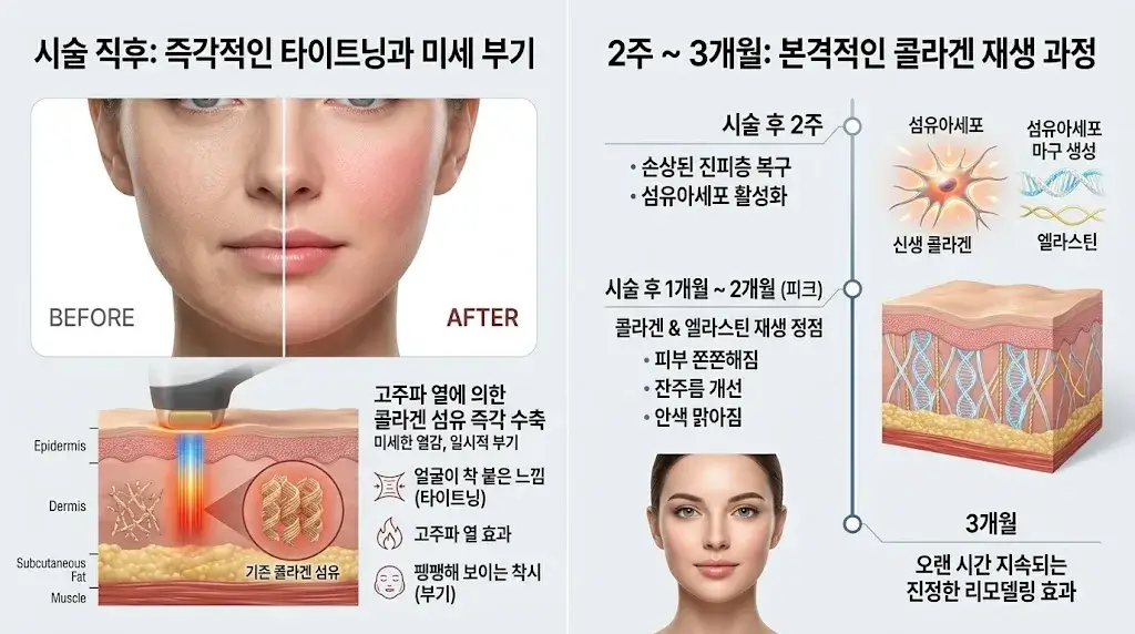 올리지오X 시술 전후 비교 콜라겐 재생 과정 시술 직후 탄력 즉각 수축 인포그래픽