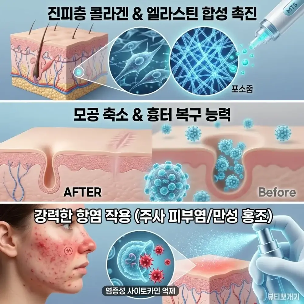 피부과 엑소좀 시술 후 진피층 콜라겐 합성 증가, 여드름 패인 흉터 복구 및 늘어진 세로 모공 축소 효과를 나타낸 임상 비교 그래픽