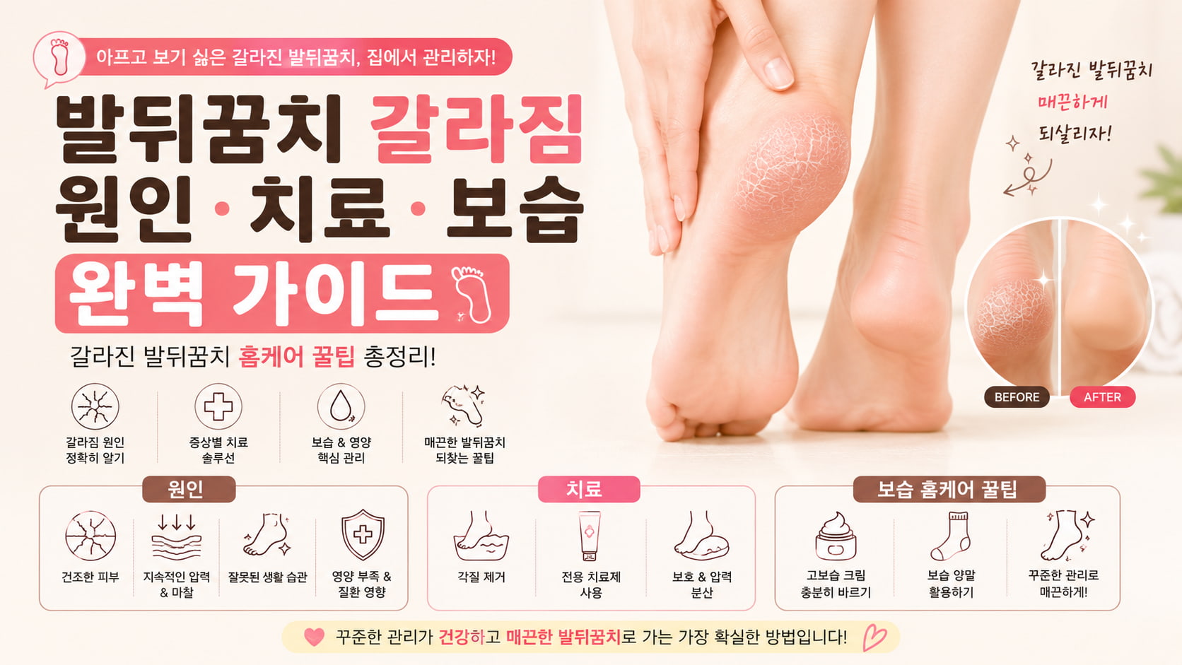 발뒤꿈치 갈라짐의 원인과 치료, 보습 및 홈케어 방법을 정리한 발각질 관리 가이드 이미지